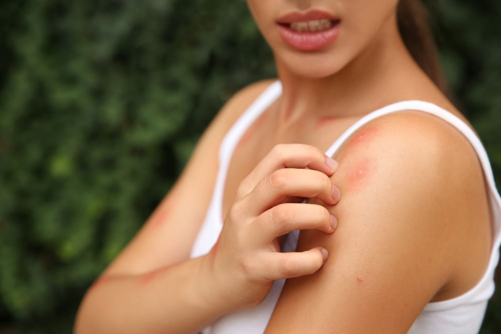 Natural remedies for mosquito bites